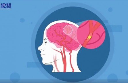 健康問答 | 關(guān)于腦中風(fēng)，患者家屬有哪些常見誤區(qū)？