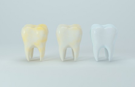 牙齒淡黃色才是健康色號？醫(yī)生提醒：洗牙并不能使牙齒變白