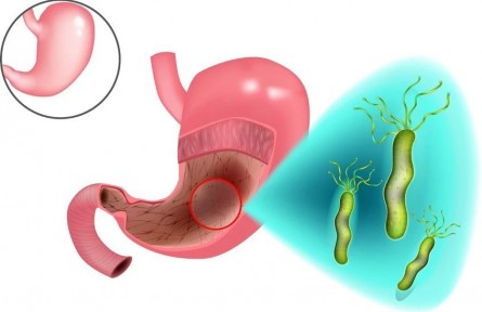 守“胃”健康，這些護(hù)胃措施請(qǐng)收好