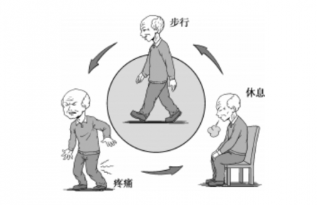 健康問(wèn)答|什么是間歇性跛行？