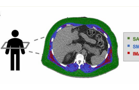 骨骼肌肌間脂肪多，心血管病風(fēng)險(xiǎn)高